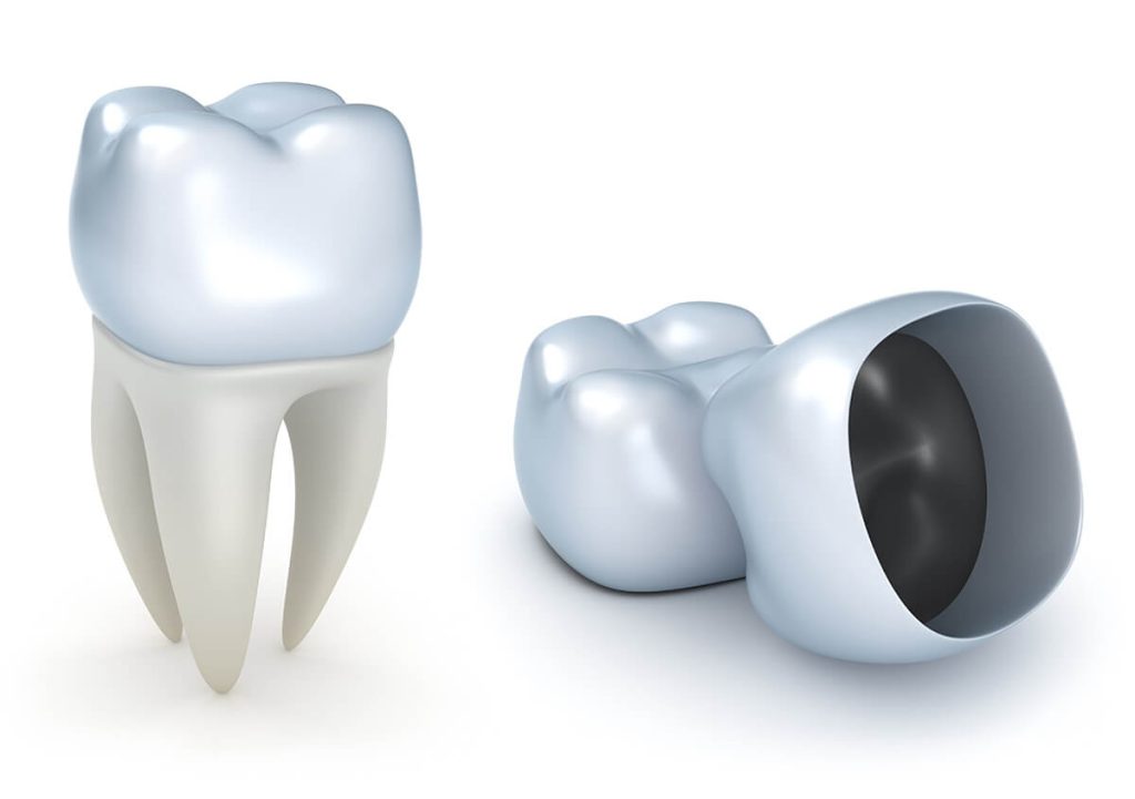 Same Day Dental Crowns in Dublin CA Area