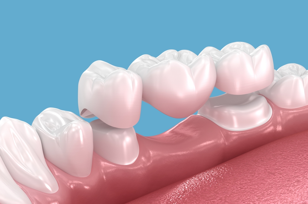 cerec same-day dental crowns