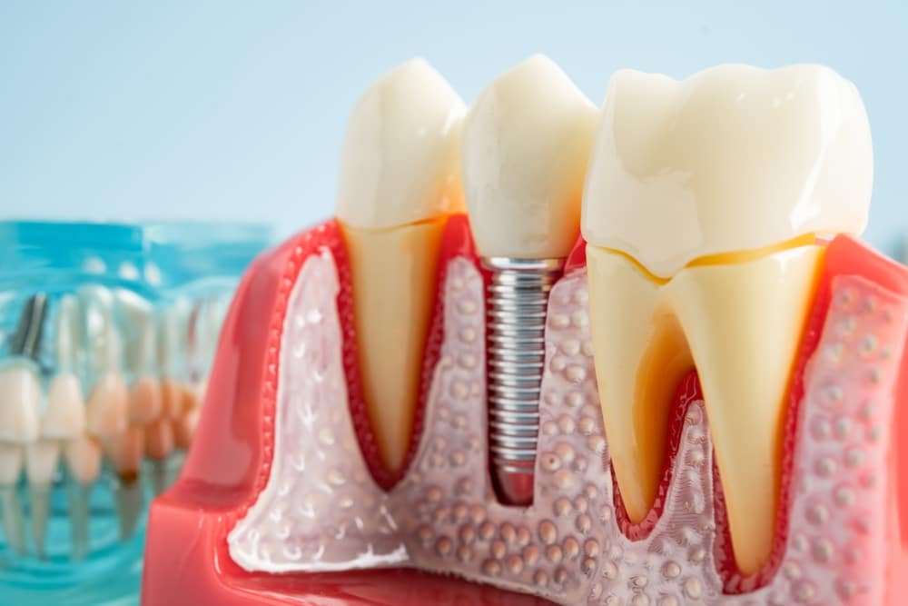 dental implants san ramon